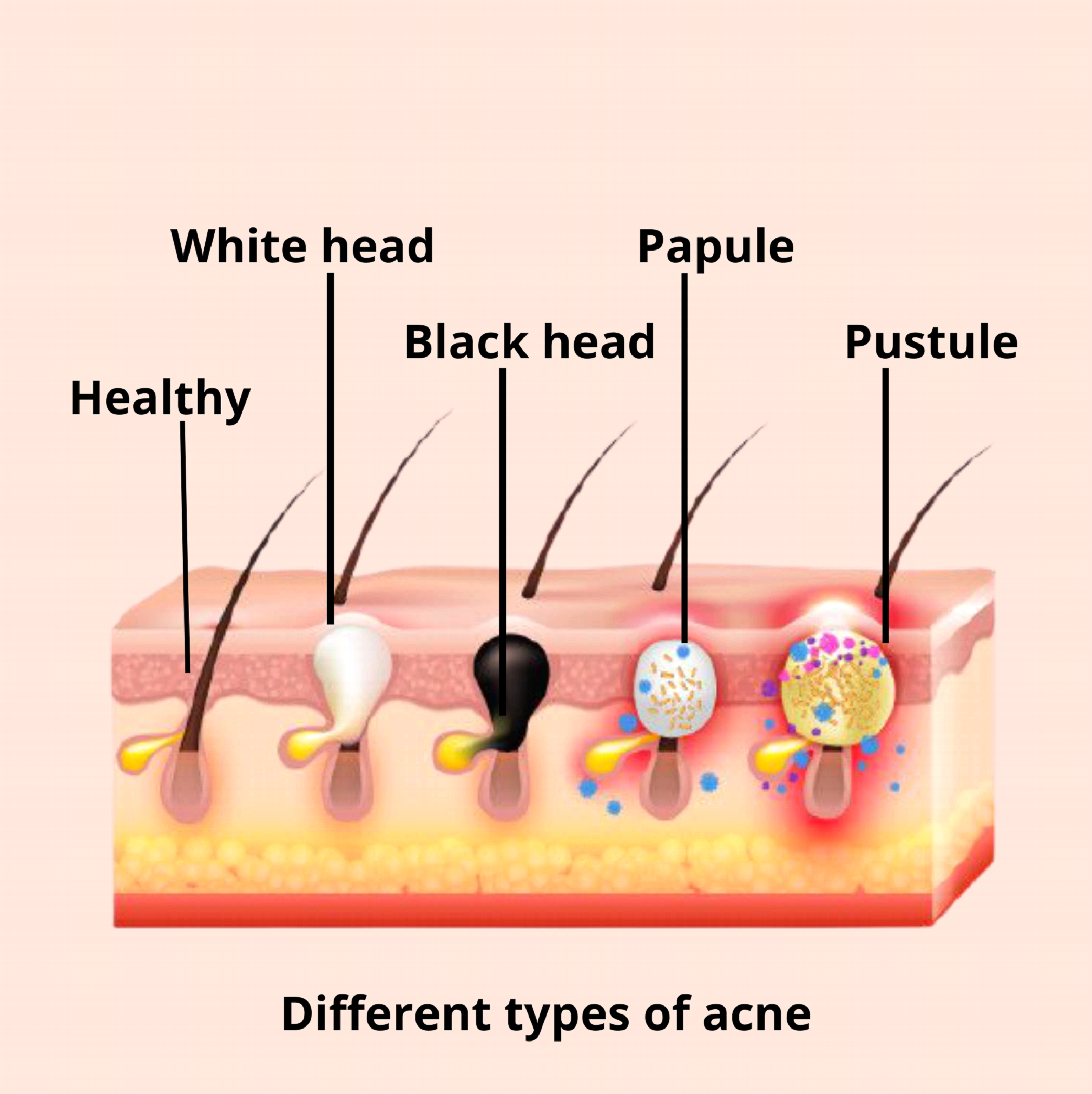 Acne Treatment in Indiranagar | Dr Swetha's Cosmoderm Centre