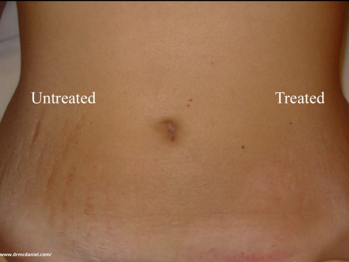 Stretch marks removal treatment in Bangalore