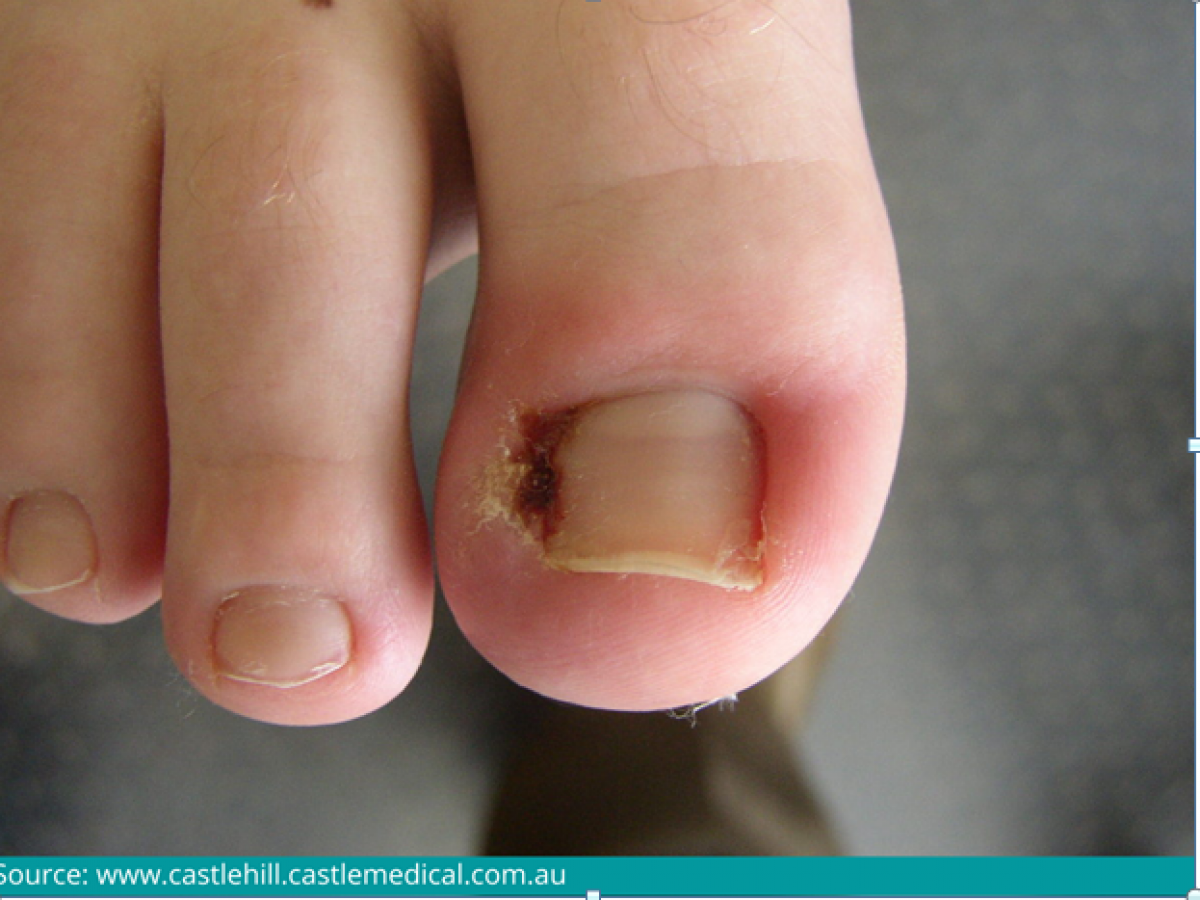 Ingrown Toe Nail Operation Dubai - London Foot & Ankle Surgery | Specialist  Foot Surgery Clinic